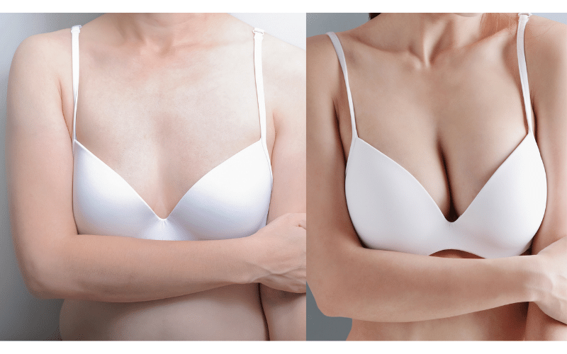 Fat Transfer Breast Augmentation Cost